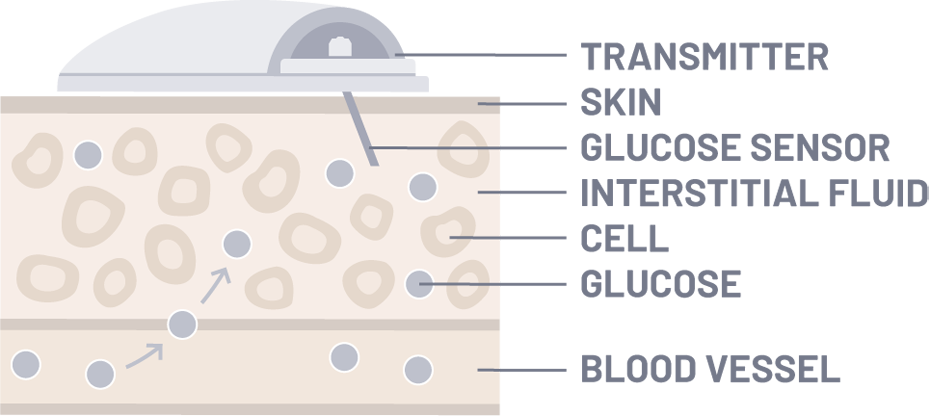 Thinking Smaller To Manage Diabetes With Continuous Glucose Monitoring Devices Cgm Analog Devices