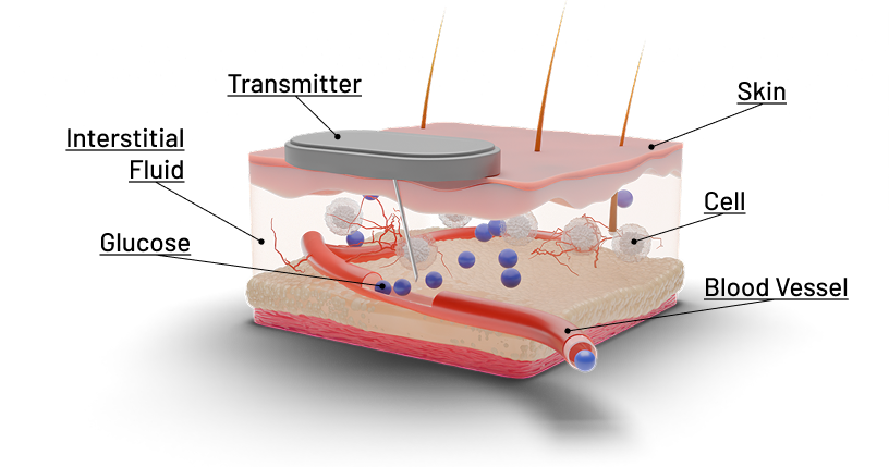 3D cross-section of skin with glucose sensor measuring interstitial fluid for blood sugar data